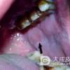 怎样预防舌扁平苔藓的发生