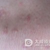 到底如何的护理传染性湿疹样皮炎