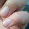 传染性湿疹样皮炎该怎样的去护理