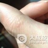 关于传染性湿疹样皮炎的日常护理