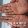 传染性湿疹样皮炎的护理要注意的事项