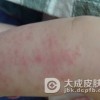 患了传染性湿疹样皮炎怎么办