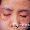 关于传染性湿疹样皮炎是什么病