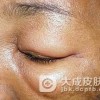 用来治疗血管神经性水肿的药膳