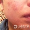 疱疹样皮炎的护理工作