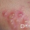 水痘的家庭护理