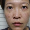 预防雀斑我们应该怎么做