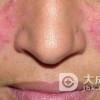 平时怎么预防酒槽鼻