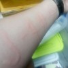 急性荨麻疹是否会传染