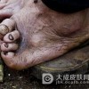 患有麻风病会有什么症状发生