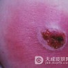 痈的发病特点有什么呢