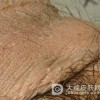 阴囊湿疹的症状类型有什么呢