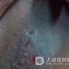 阴囊湿疹的预防方法