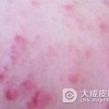 阴囊湿疹发病后有哪些症状
