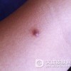 皮肤纤维瘤的正确认识