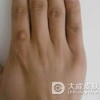皮肤纤维瘤是怎样形成的