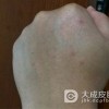 梅毒的诊断方法