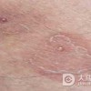 传染性红斑的发病原因是什么呢？