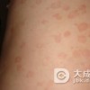 传染性红斑的治疗措施有哪些？