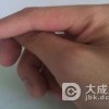 青少年汗疱疹患者如何进行日常护理