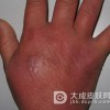 类丹毒是怎样引起的