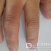 类丹毒有哪些类型呢