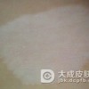 白癜风有什么明显的症状吗