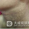 摩擦性黑变病的介绍及检查