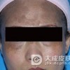 皮肤黑变病及摩擦性黑变病的诊断