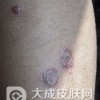 扁平苔藓是怎么回事吗