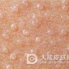 口腔扁平苔藓会引发哪些的其他病症