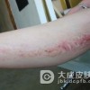 关于扁平苔藓的分类