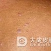 扁平苔藓的主要的症状都有什么？
