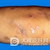扁平苔藓六大特点是什么