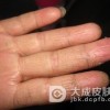 肠病性肢端皮炎的临床体征有什么