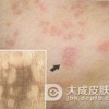 肠病性肢端皮炎有什么表现吗