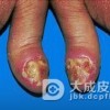 肠病性肢端皮炎有的临床症状
