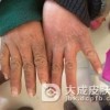 冬季要如何预防冻疮呢