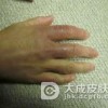 预防冻疮的好方法都有什么呢