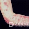 患脓疱疮的注意事项有哪些