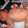 生活中脓疱疮的注意事项有哪些