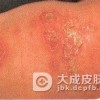 新生儿脓疱疮的预防常识