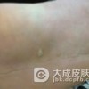 寻常疣常见的一些治疗偏方有哪些