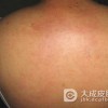 硬肿症的病发表现有哪些呢