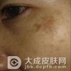 黄褐斑临床的主要症状有哪些具体内容