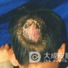 什么原因导致头癣疾病的出现