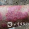 气候也是银屑病的诱因