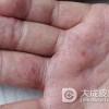 手癣与汗疱疹怎样进行区别呢