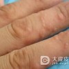 汗疱疹治疗有哪些方法