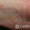 汗疱疹治疗的方法都有什么呢